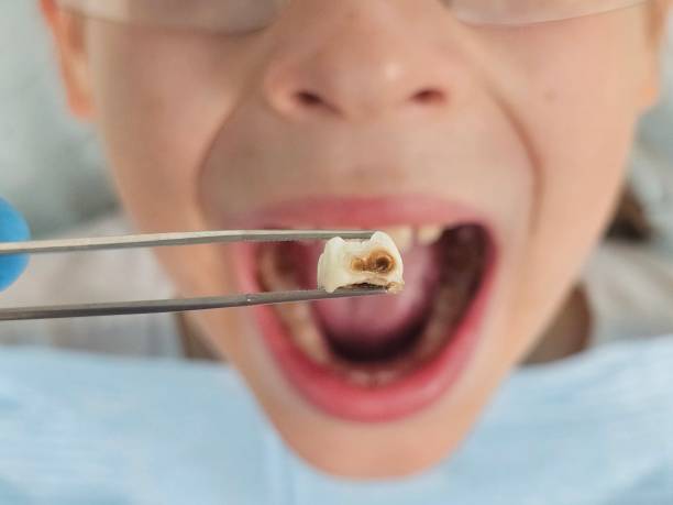 Best Emergency Tooth Extraction in Mililani Town, HI